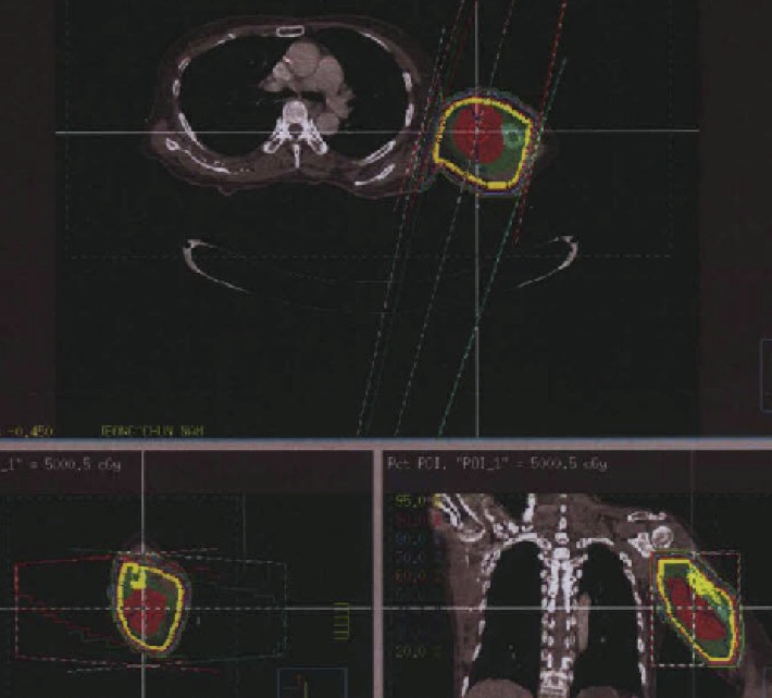 Figure 3 for case Radiation induced myonecrosis